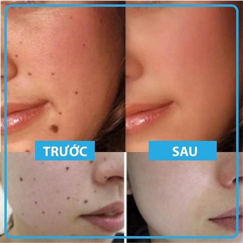 Gel Tẩy Nốt Ruồi DVELINIL Nga Tẩy Nốt Ruồi, Mụn Cơm, Mụn Cóc, Mụn Thịt