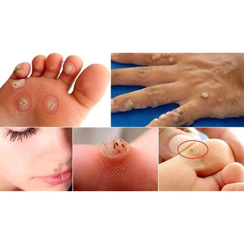 Gel Tẩy Nốt Ruồi DVELINIL Nga Tẩy Nốt Ruồi, Mụn Cơm, Mụn Cóc, Mụn Thịt