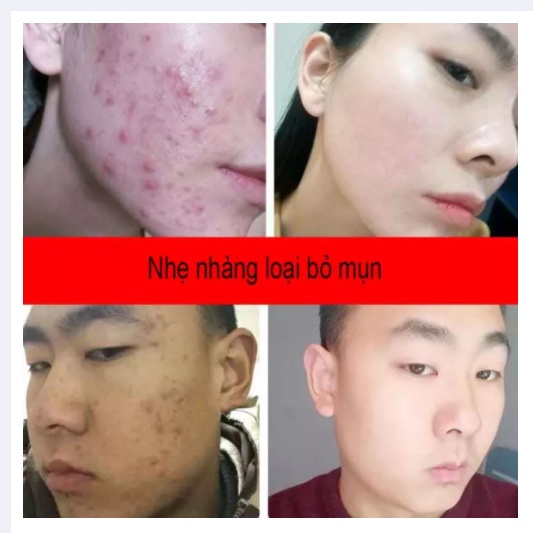 Gel nha đam Gel Lô Hội Kem Mụn 40g làm mờ vết thâm sẹo phục hồi sẹo phục hồi sau cháy nắng giảm thâm kem giữ ẩm