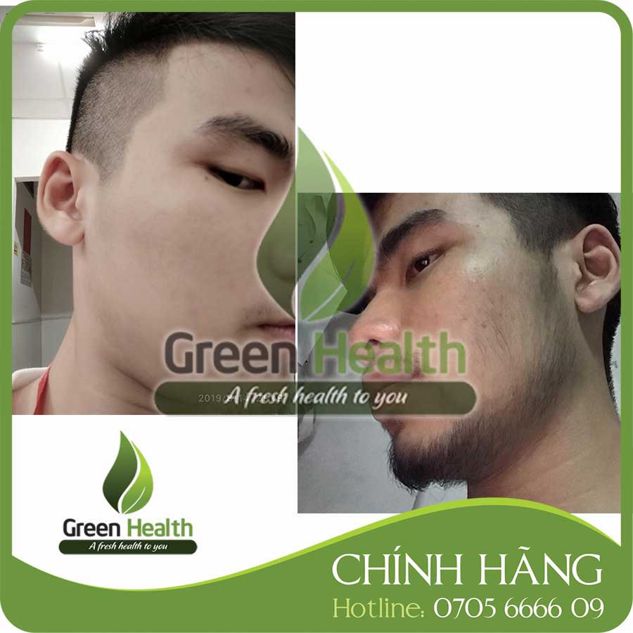 Hộp 6 chai mọc râu tóc Minoxidil 5% dạng lỏng mẫu 2023 – Tặng 2 LCLT