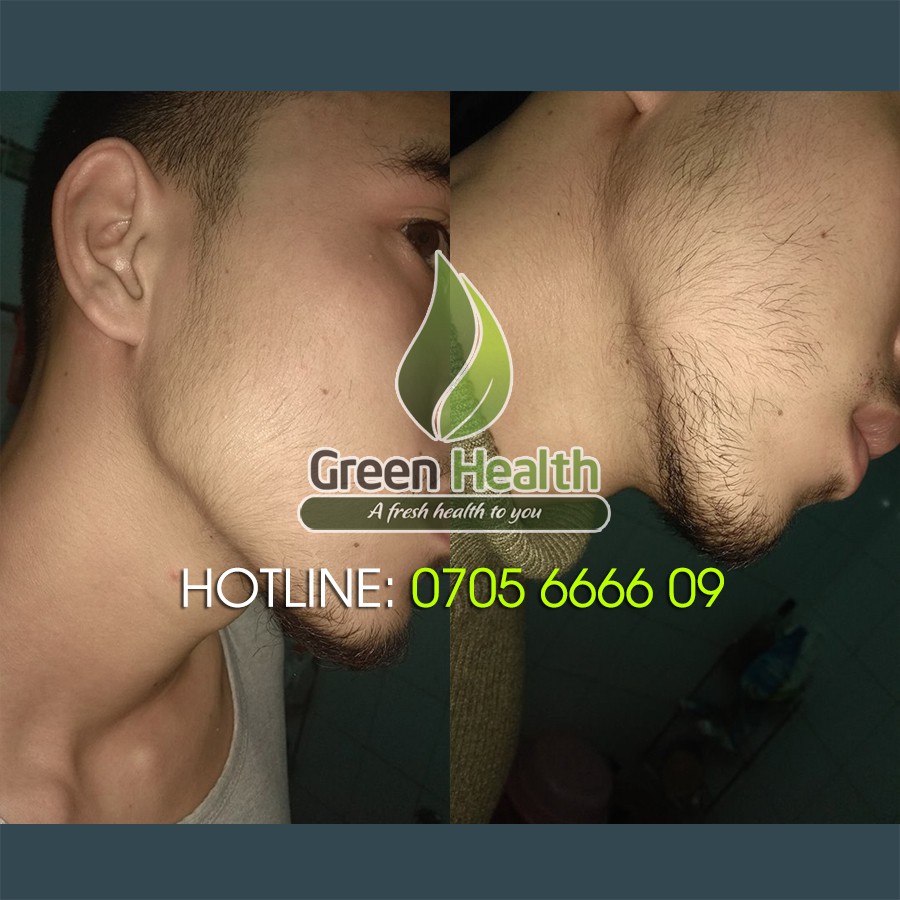 Serum mọc râu tóc Minoxidil 5% dạng bọt