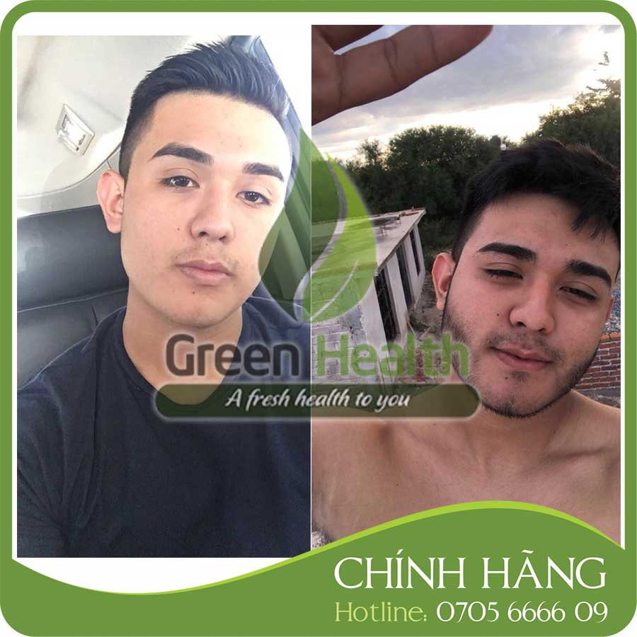 Hộp 6 chai mọc râu tóc Minoxidil 5% dạng lỏng mẫu 2023 – Tặng 2 LCLT