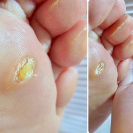 Dung dịch loại bỏ dứt điểm Mụn cóc Mụn cơm Ibokorori của Nhật Bản