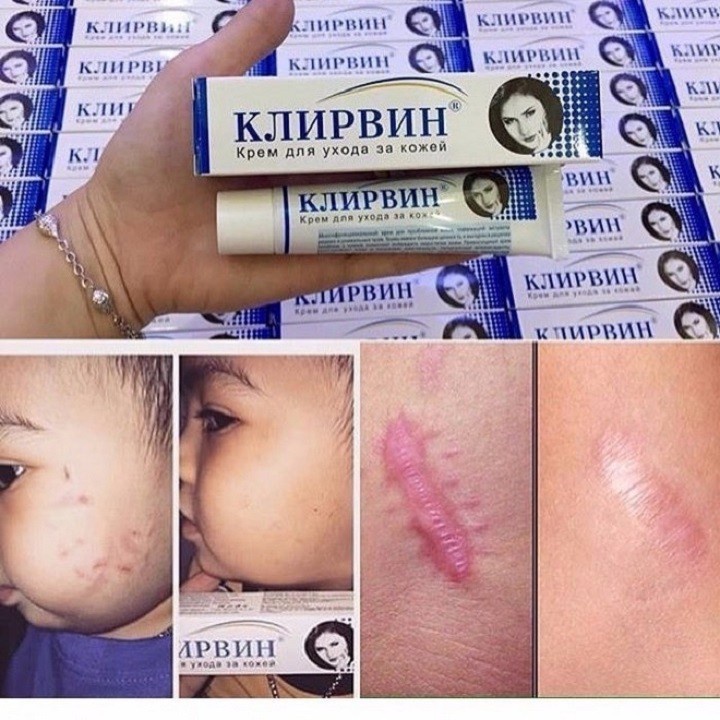 Kem Mờ Sẹo Kirvin Mờ Xẹo Thâm, Lồi Lõm Sẹo Rỗ Giảm Mụn Rạn Da, Hồi Phục Da