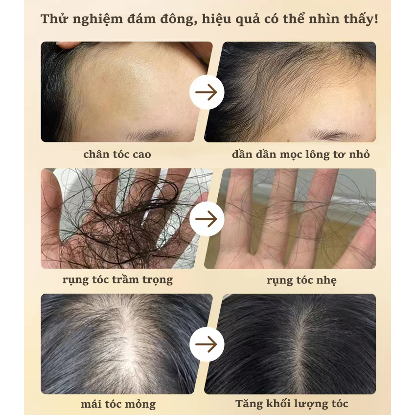 Dầu gội mọc tóc kích thích mọc tóc dầu gội chống rụng tóc [300ml] loại bỏ gàu, dưỡng tóc