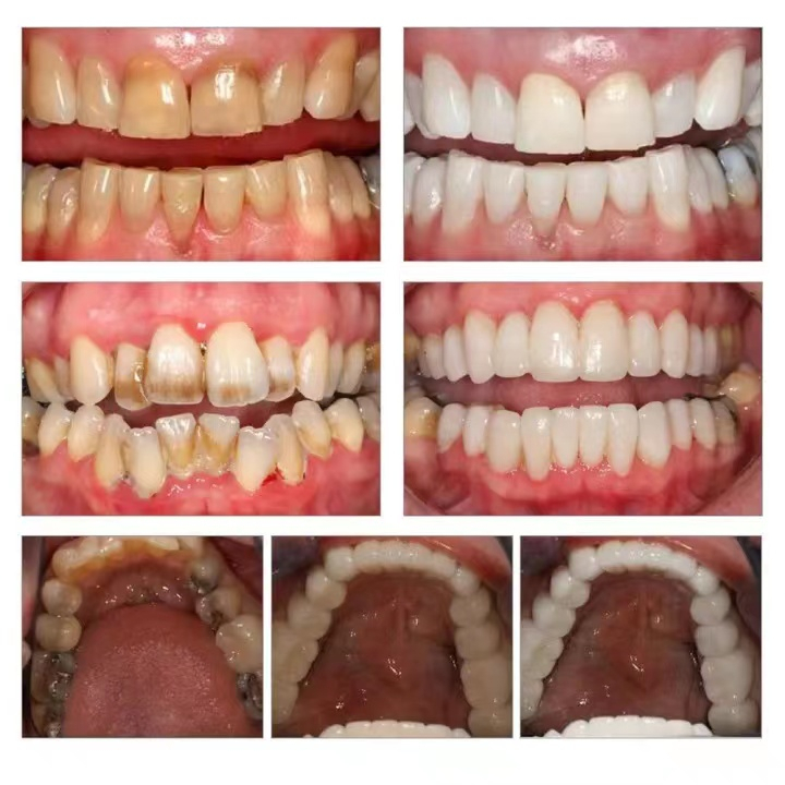 Bột làm trắng răng kem đánh răng làm trắng răng 50g Làm trắng răng nhanh chóng, hết ố vàng, cao răng, khử mùi hôi miệng, giảm viêm loét miệng, chăm sóc nướu