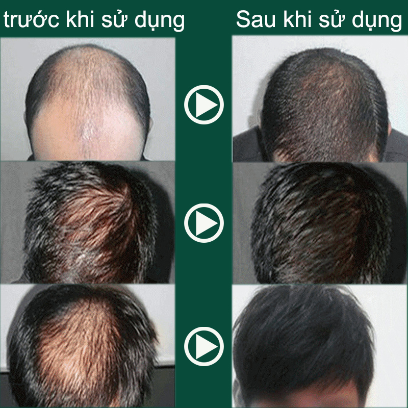 👍🏻Chính Hãng👍🏻Tinh chất mọc tóc tinh dầu mọc tóc 30ml serum kích mọc tóc chăm sóc tóc chống rụng tóc,kích thích tóc mọc dà🔥 Rẻ nhất 🔥
