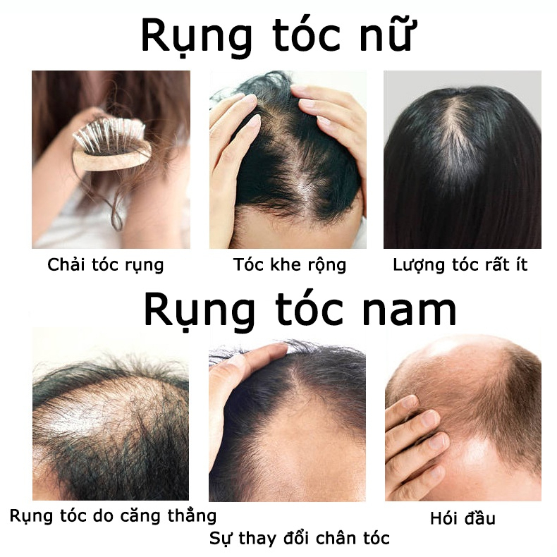👍🏻Chính Hãng👍🏻Tinh chất mọc tóc tinh dầu mọc tóc 30ml serum kích mọc tóc chăm sóc tóc chống rụng tóc,kích thích tóc mọc dà🔥 Rẻ nhất 🔥