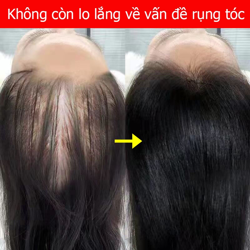 ❤️100% Chính Hãng❤️（Hiệu quả sau 7 ngày）Serum mọc tóc Tinh chất dưỡng tóc Tinh Chất Chống Rụng Tóc 30ml kích thích mọc tóc nhanh làm dàygiúp giảm rụng tóc giải quyết vấn đề rụng tóc do lão hóa / hói đầu sau sinh