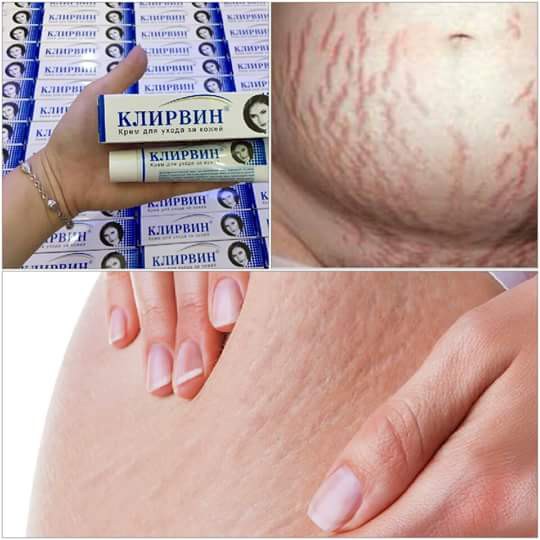 Kem sẹo Nga, Kem mờ sẹo thâm, loại bỏ sẹo lồi lõm,rạn da chỉ trong 2 tháng Klirvin Nga
