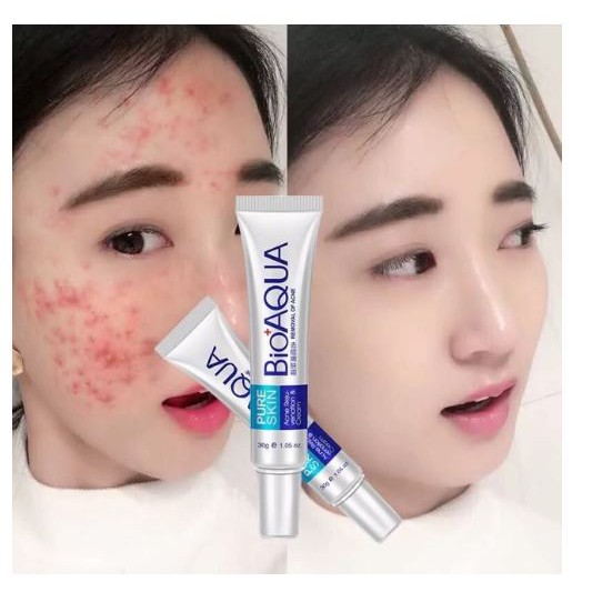 [SIÊU HOT] Kem dưỡng da MỤN trắng da BIOAQUA CỰC TỐT – Kem Lành Mụn Nội Địa Trung B33