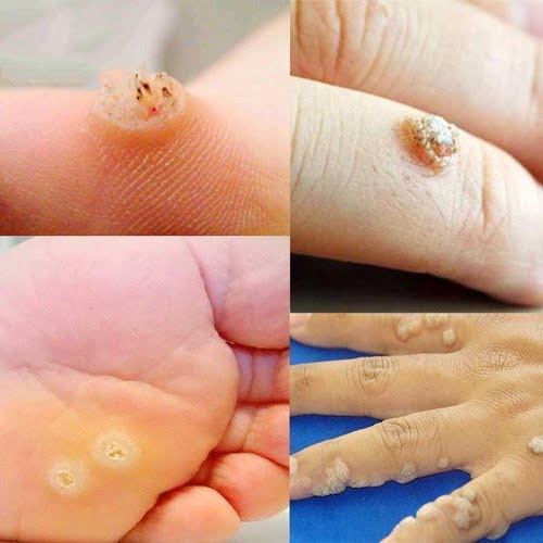 Dung dịch loại bỏ dứt điểm Mụn cóc Mụn cơm Ibokorori của Nhật Bản