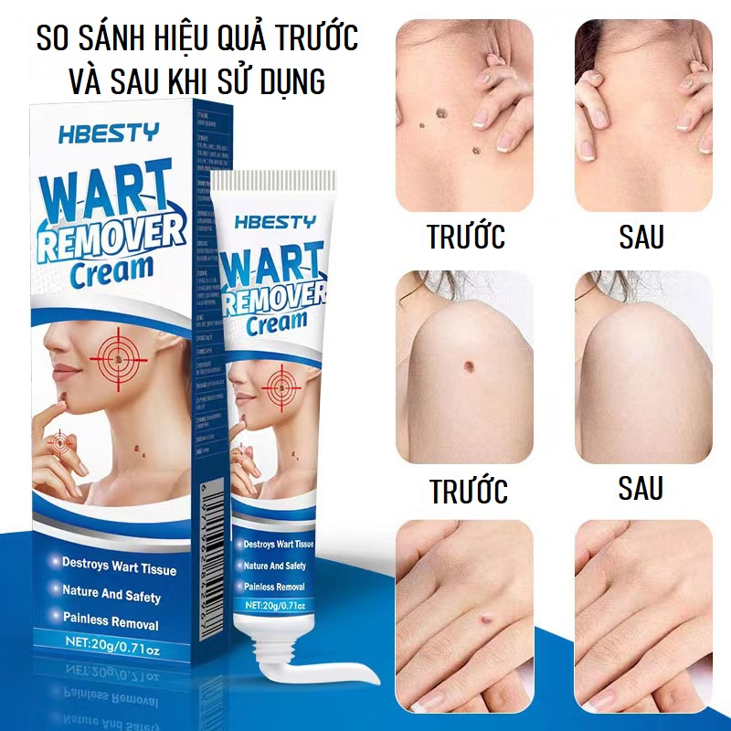 Kem Loại Bỏ Mụn HBESTY Wart Remover Cream Cam Kết Loại Bỏ Mụn Cóc, Mụn Thịt, Sẹo Lồi Gây Hại Cho Da