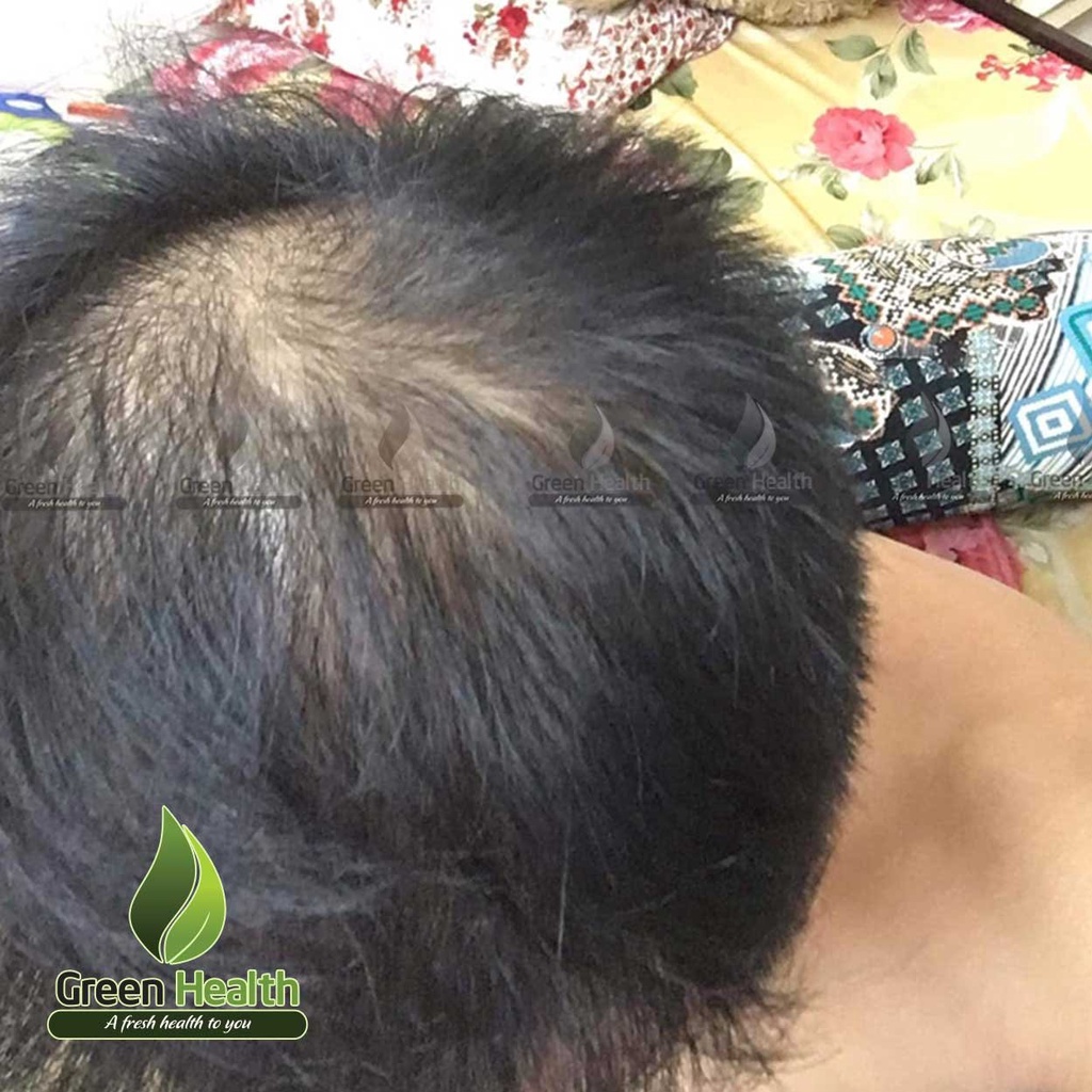 PEO mix Minoxidil hỗ trợ mọc râu nhanh