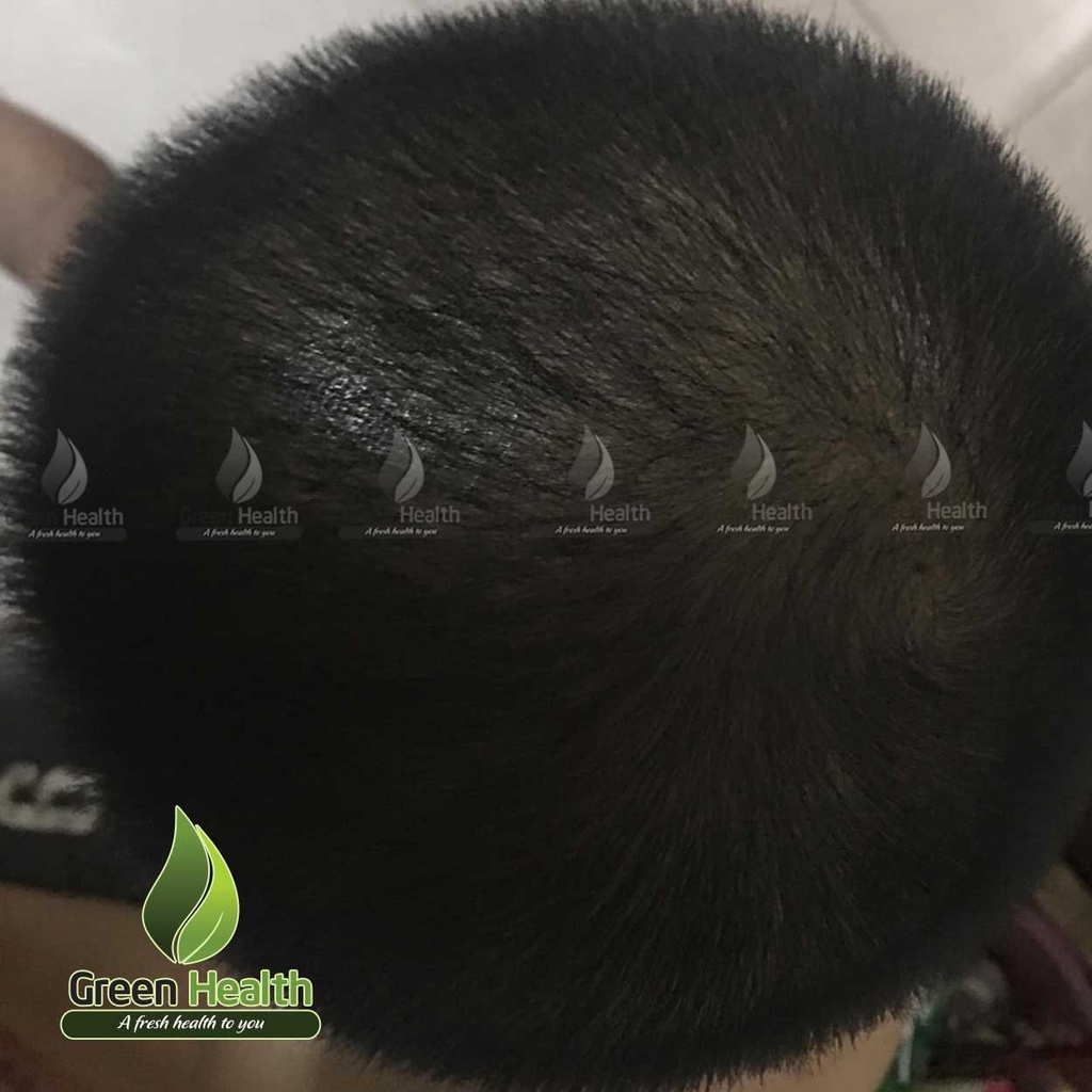 PEO mix Minoxidil hỗ trợ mọc râu nhanh