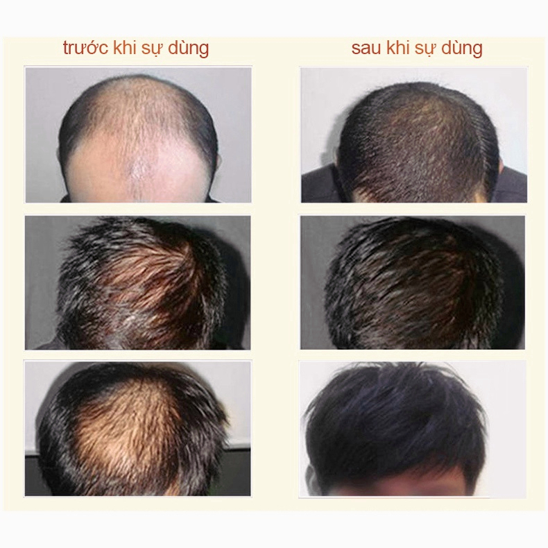 Dầu gội kích thích mọc tóc Dầu gội mọc tóc Giảm Gãy Rụng Dầu Gội Mọc Tóc Nhanh kiểm soát dầu loại bỏ gàu