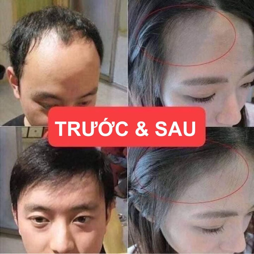 [VIỆT BEAUTY] Xịt mọc tóc Minoxidil Bailleul 2%-NHẬP TRỰC TIẾP PHÁP-NGĂN RỤNG TÓC, KÍCH THÍCH MỌC TÓC [Hộp 3 lọ 60ml]