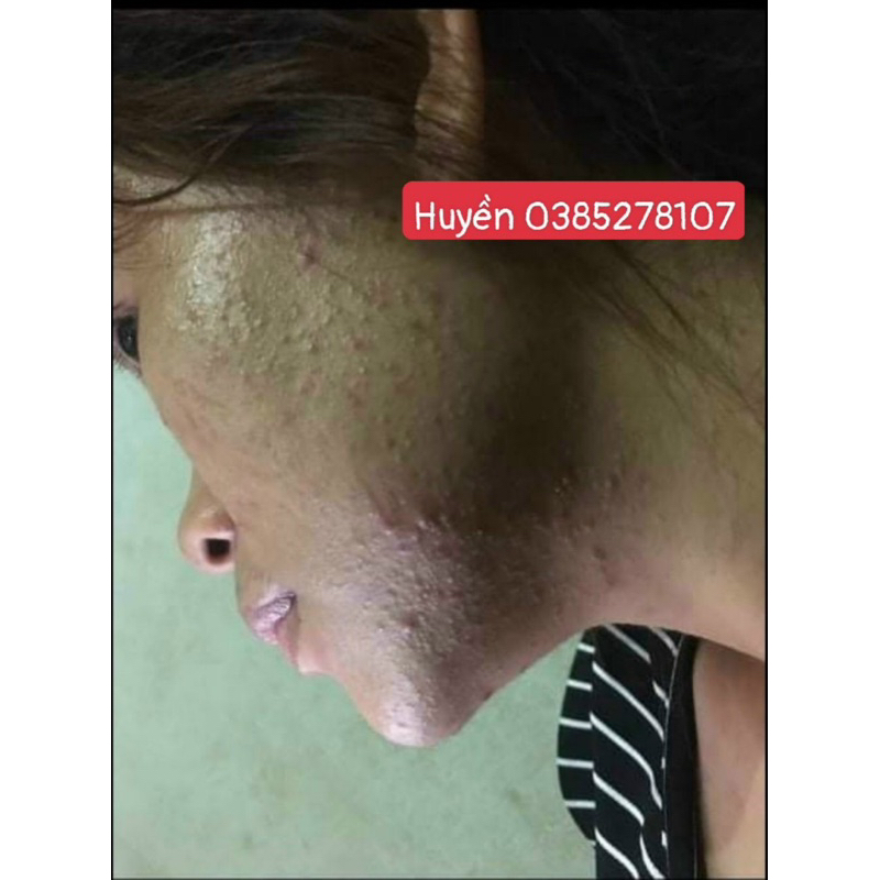 [HÀNG CHUẨN -DATE MỚI KÈM Quà Tặng ] SERUM HUYẾT THANH MỘC  TUYẾT CAM KẾT HIỆU QUẢ