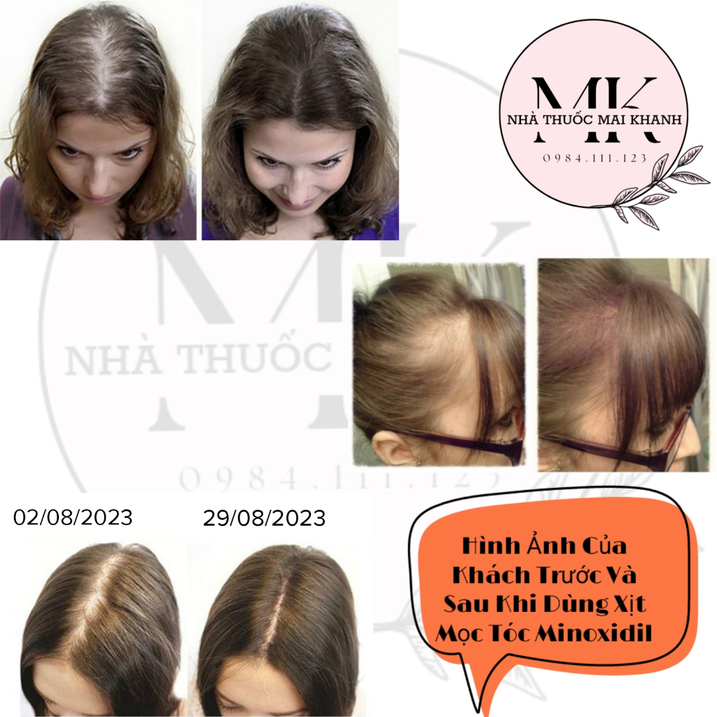 Xịt mọc tóc Minoxidil Bailleul 2% NHẬP KHẨU PHÁP – NGĂN RỤNG TÓC, KÍCH THÍCH MỌC TÓC Hộp 3 lọ 60ml.