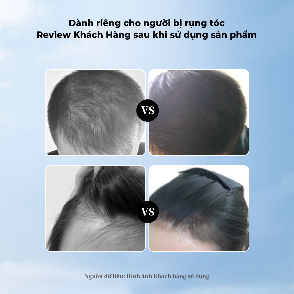 Dafexin Minoxidil Xịt Mọc Tóc 5% và 2% Dùng Cho Cả Nam và Nữ, Ngăn Ngừa Rụng Tóc và Phục Hồi Tóc