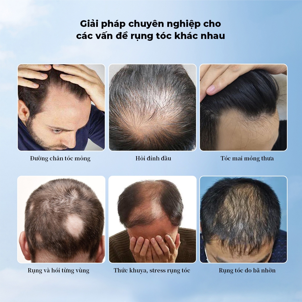 Dafexin Minoxidil Xịt Mọc Tóc 5% và 2% Dùng Cho Cả Nam và Nữ, Ngăn Ngừa Rụng Tóc và Phục Hồi Tóc