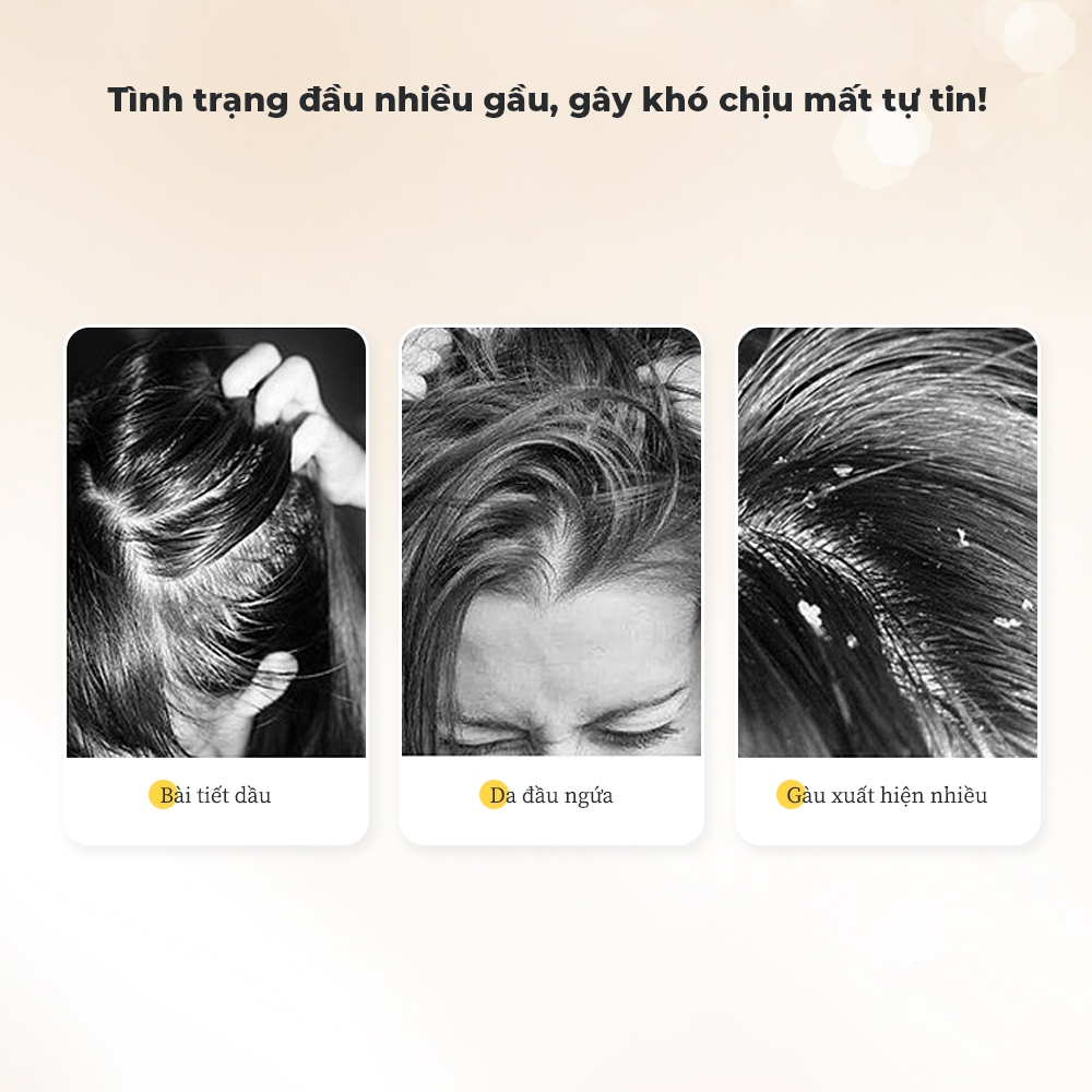 Dafeixin Dầu Gội Trị Gàu Anti-Dandruff Shampoo 300ml – Chuyên biệt cho gàu, nấm ngứa da đầu