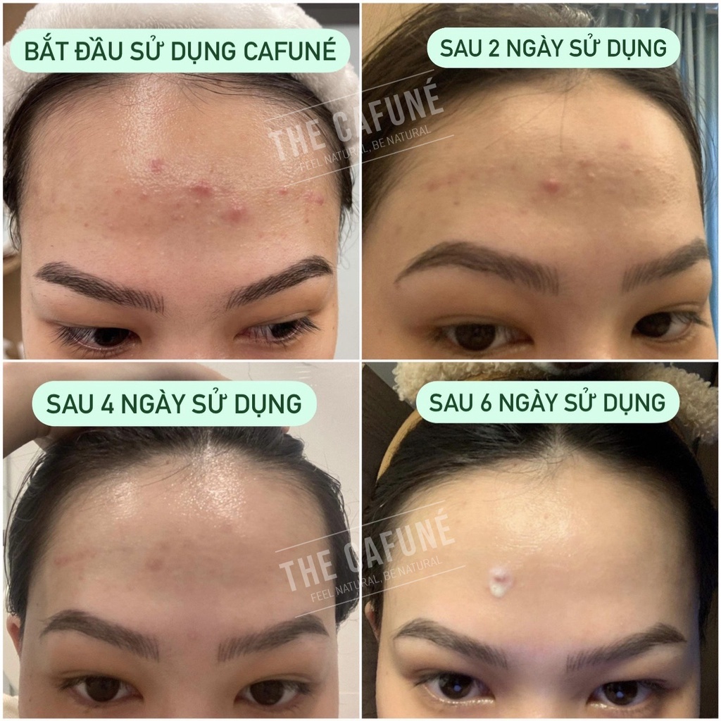 Kem Giảm Mụn Và Thâm Cafuné Essence 15gr