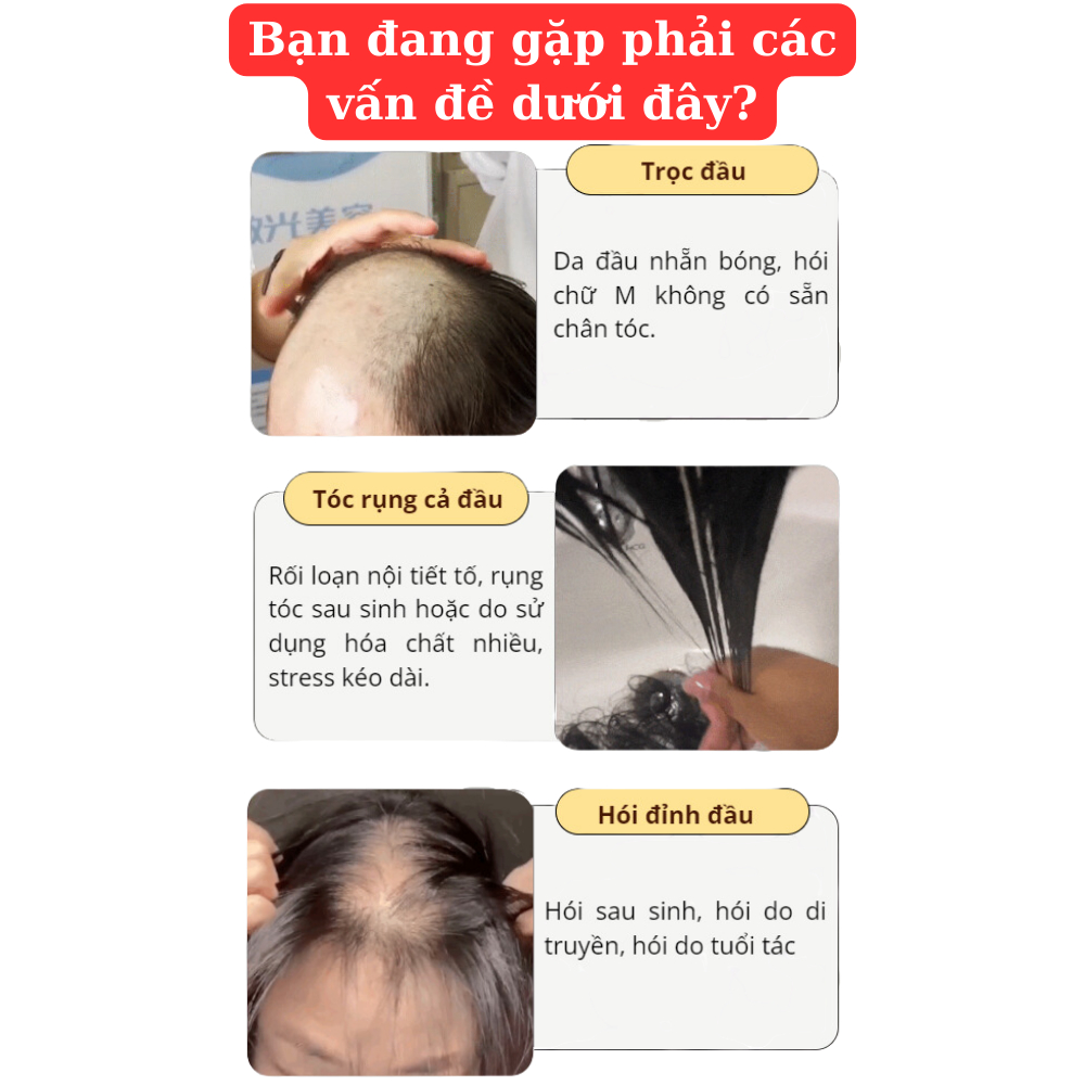 Dầu gội mọc tóc giảm gàu DHT – Dầu gội DHT kích thích mọc tóc, giảm gàu, nấm ngứa, bảo vê nang tóc chắc khỏe