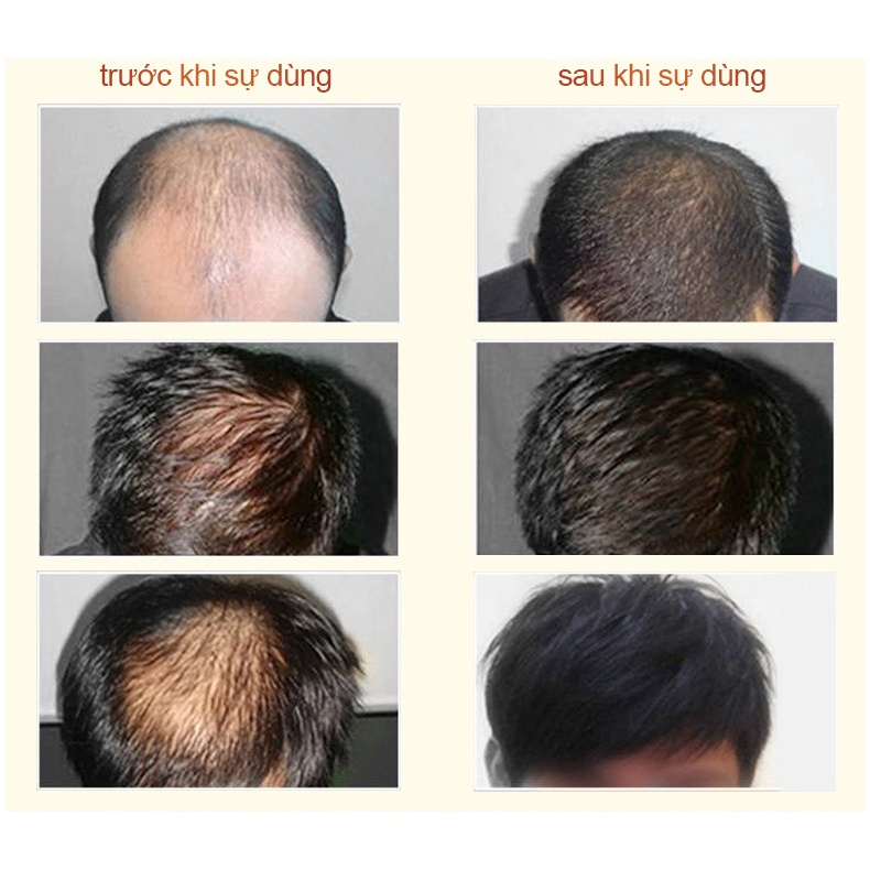 Dầu gội kích thích mọc tóc Dầu gội mọc tóc Giảm Gãy Rụng nơi rụng tóc Nhanh kiểm soát dầu loại bỏ gàu
