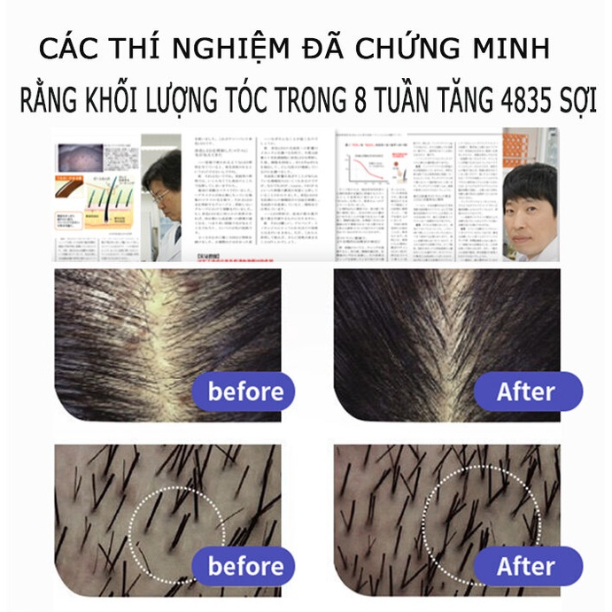 Dầu gội kích thích mọc tóc Dầu gội mọc tóc Giảm Gãy Rụng nơi rụng tóc Nhanh kiểm soát dầu loại bỏ gàu