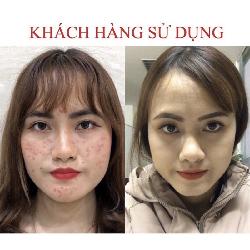 Serum giảm mụn thâm rỗ SEIMY 10ml Skin 7 Days, giảm thâm, dưỡng trắng da