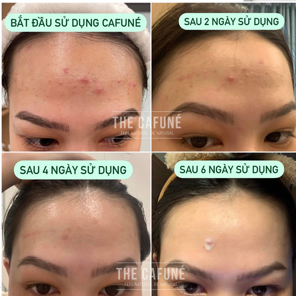 Kem giảm mụn The CafuNé Essence Chính Hãng 15ml Gel Tinh Chất Dưỡng Bôi Giảm Mờ Thâm Lột Mụn Dầu Ẩn Đầu Đen Trứng Cá