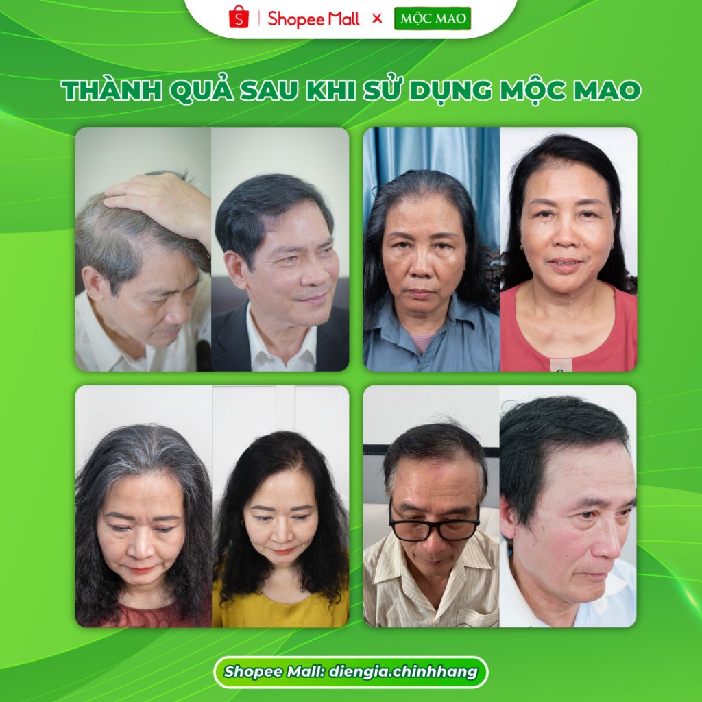 Viên Uống Mọc Tóc Mộc Mao – An Toàn, Tự Nhiên, Hỗ Trợ Làm Đen Tóc, Giảm Xơ, Rối, Chẻ Ngọn, Gãy Rụng, Nấm Ngứa, Viêm Da