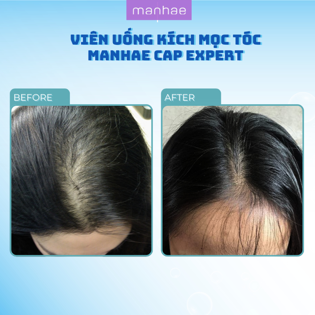 Viên uống kích mọc tóc Manhae Cap Expert chống rụng tóc giúp phục hồi và chăm sóc tóc chắc khỏe