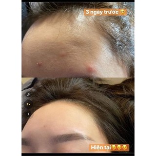 Serum giảm mụn thâm rỗ - Skin 7 Days - Công dụng 5 trong 1 hiệu quả sau 7 ngày