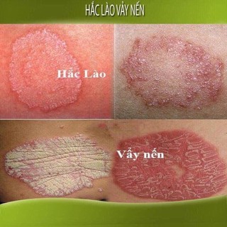 Kem bôi bọ cạp vàng vua các loại nấm ngứa hắc lào, viêm da, tổ đỉa, vẩy nến, á sừng