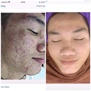 Serum giảm mụn thâm rỗ - Skin 7 Days - Công dụng 5 trong 1 hiệu quả sau 7 ngày