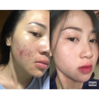 Serum giảm mụn thâm rỗ - Skin 7 Days - Công dụng 5 trong 1 hiệu quả sau 7 ngày