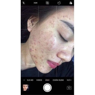 Serum giảm mụn thâm rỗ - Skin 7 Days - Công dụng 5 trong 1 hiệu quả sau 7 ngày
