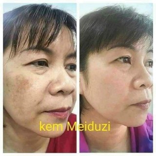 Combo Kem MEIDUZI Face Ngày và Đêm Nhật MEIDUZI Giúp Dưỡng Trắng Mờ Thâm Nám Sáng Mịn Da