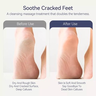 ENCHEN Foot Dead Skin Callus Remover Dụng cụ chăm sóc bàn chân bằng điện với 3 đầu lăn đá mài chống thấm nước