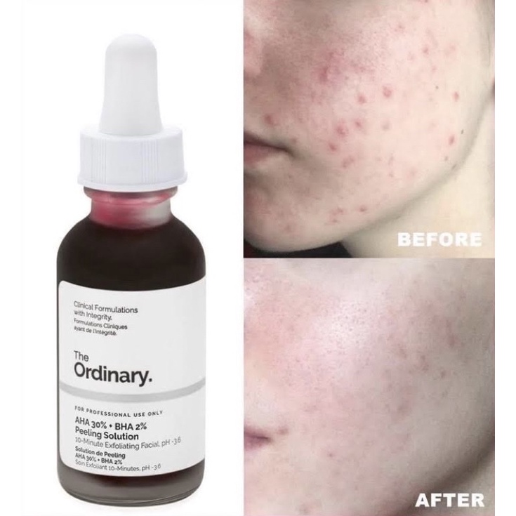 Tinh Chất Peel da The Ordinary AHA 30%+BHA 2% Peeling Solution 30ml