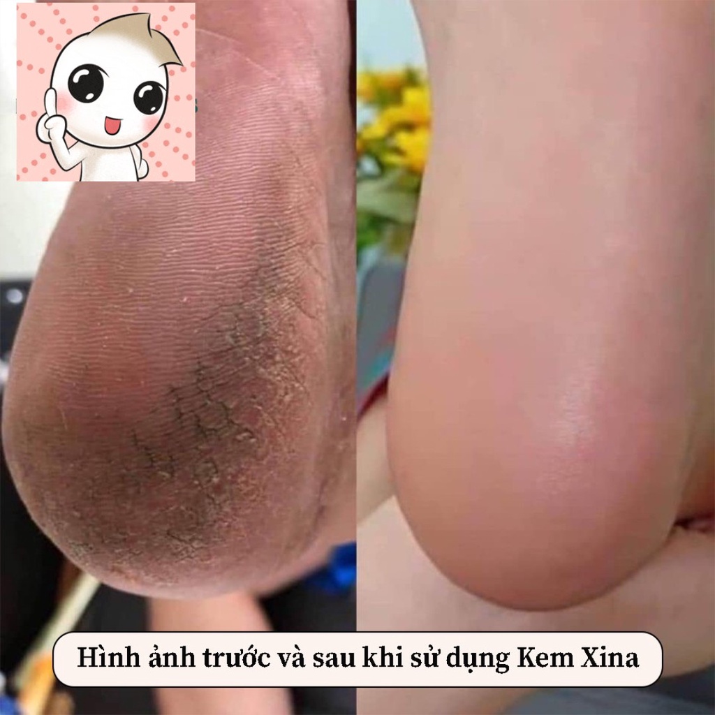 [GIÁ TỐT] Kem mềm da nail Xina chính hãng - Kem làm mềm da cải thiện tình trạng thô ráp, sần sùi mùi ngẫu nhiên