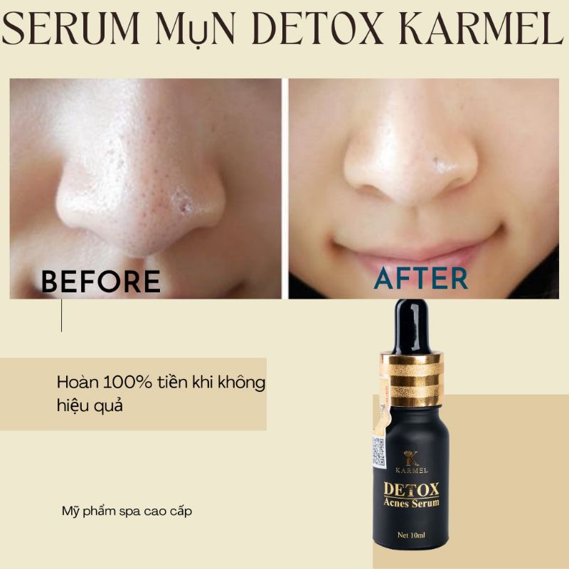 💥💥💥Serum Detox Dành cho da mụn hiệu quả cao.10ml