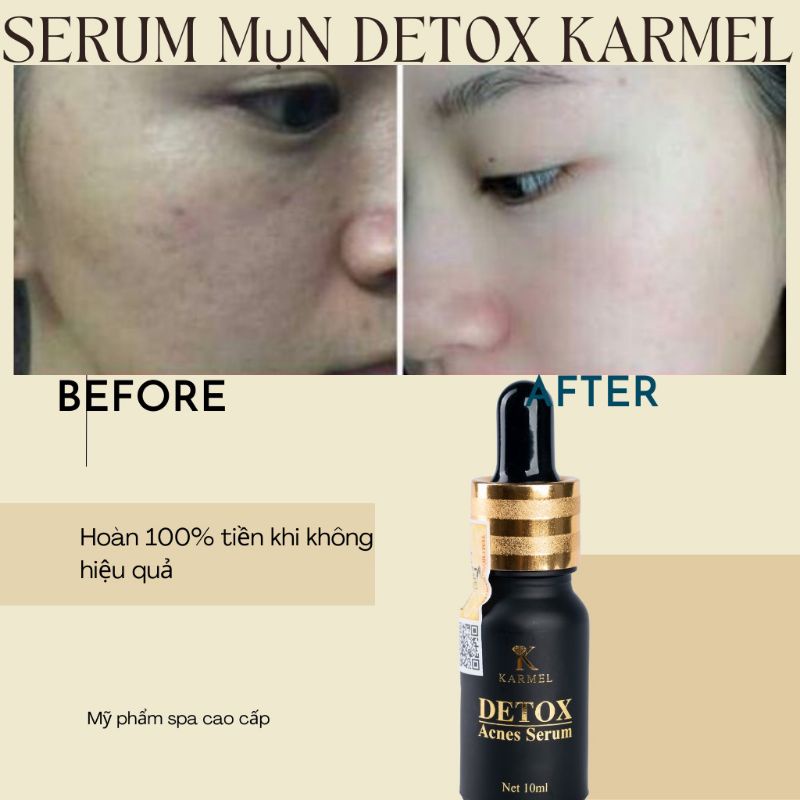 💥💥💥Serum Detox Dành cho da mụn hiệu quả cao.10ml