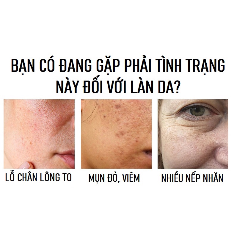 Serum Niacinaide Ngăn Ngừa Và Giảm Mụn, Dưỡng Trắng Da