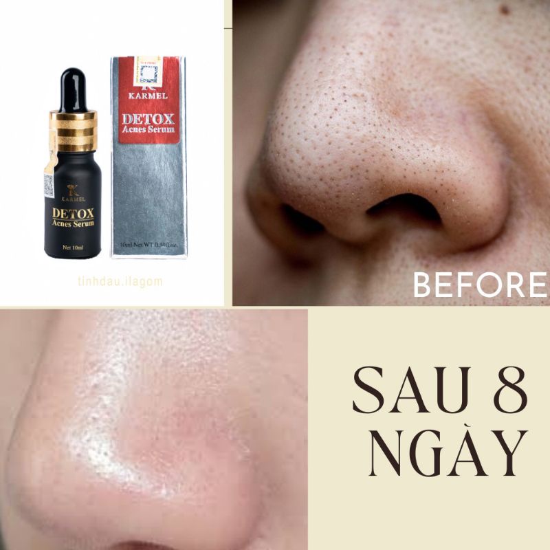💥💥💥Serum Detox Dành cho da mụn hiệu quả cao.10ml