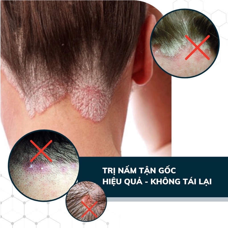 COMBO 4 Dầu Gội Đầu DEGO PHARMA 80ml Dứt Điểm Gàu Ngứa & Nấm Da Đầu