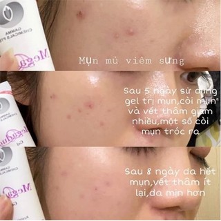 Gel giảm mụn ẩn, giảm thâm Megaduo Gel 15g, Megaduo Chính Hãng Cho Da Mụn, Thâm Mụn