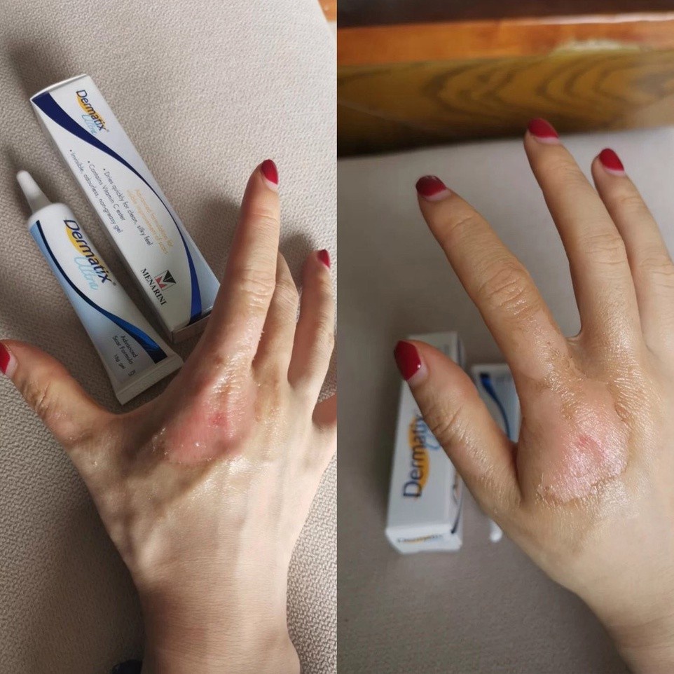 Ảnh Kem giảm sẹo EELHOE Dermatix 15g hỗ trợ giảm sẹo mụn phục hồi 4